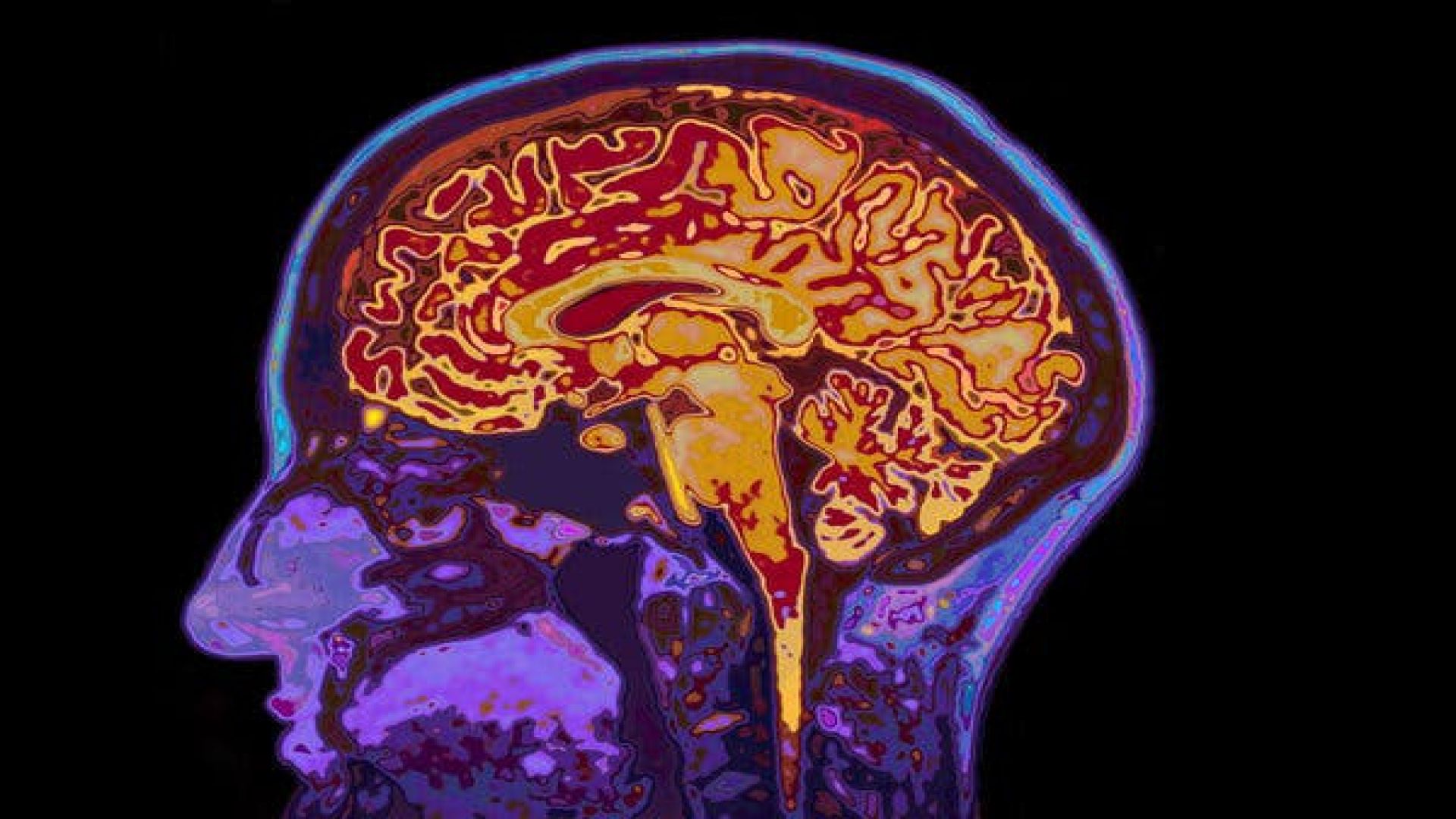 Bilingualism May Stave Off Dementia, Study Suggests